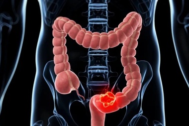 Estos son los síntomas que alertan del cáncer de colon