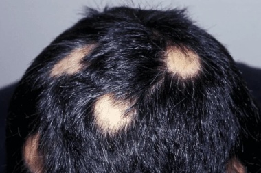 Alopecia: prueban una pastilla para hacer crecer el pelo